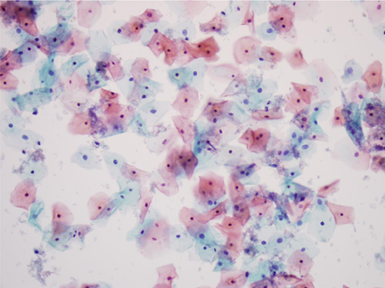 Negative for intraepithelial lesion and malignancy