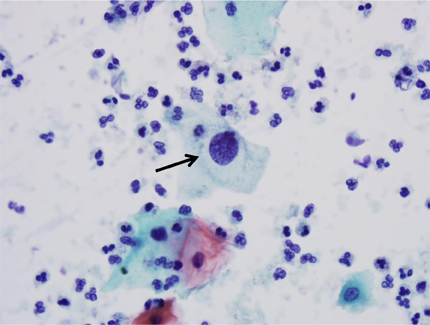 Low grade squamous intraepithelial lesion