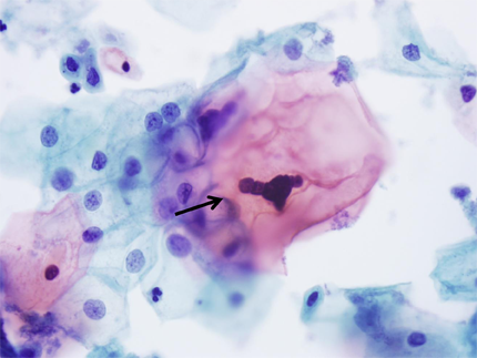 LSIL occurring in the background of HSIL