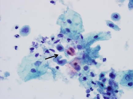 High grade squamous intraepithelial lesion